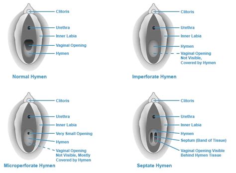 broken hymen|What Is the Hymen: Anatomy, Functions, Types and。